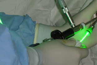 Laser Verde